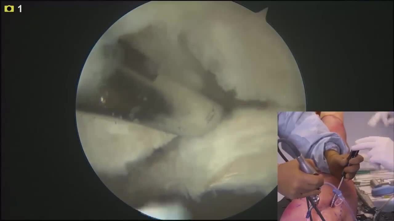 VERSALOOP Hip Labral Repair Video