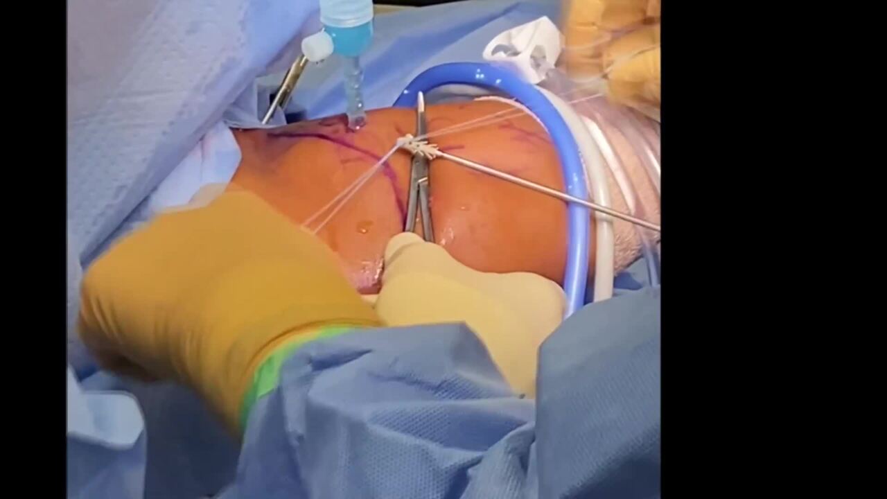 Proximal Biceps Tenodesis Procedure Highlights Video with Dr. Kevin Bonner