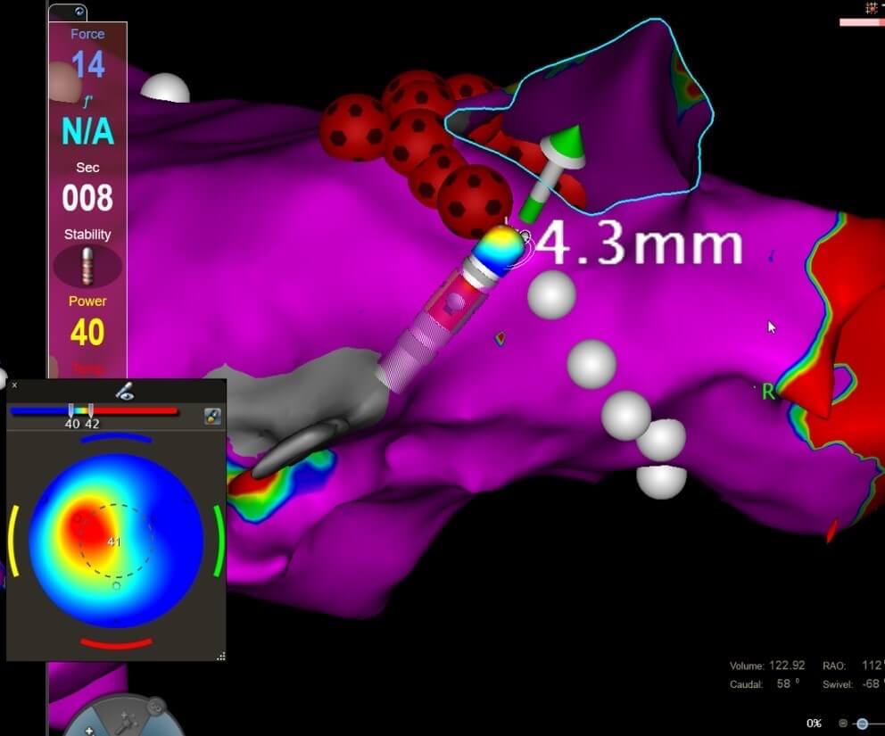 Biosense Webster mapping system with QDOT Micro® Ablation Catheter