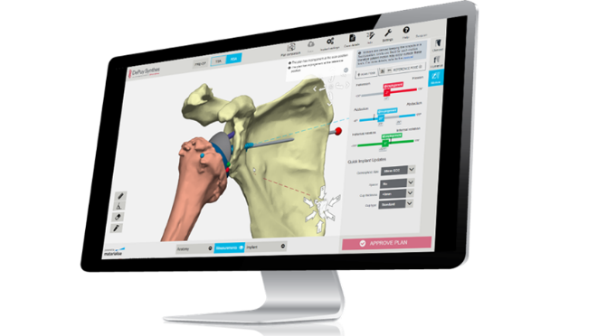 Computer monitor showing the TRUMATCH personalized solutions shoulder system interface on the screen 