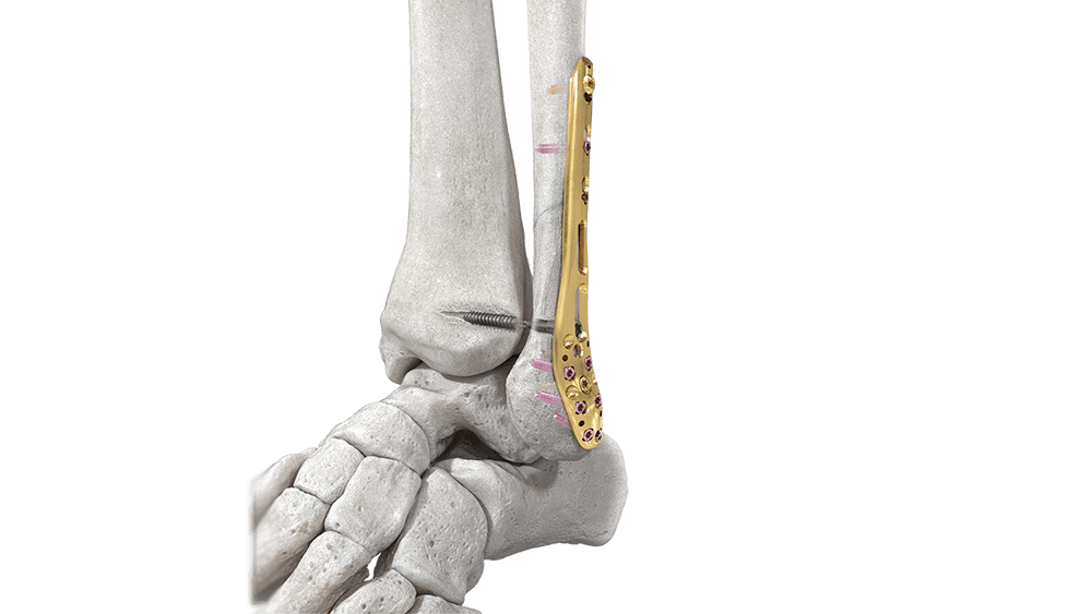 Variable Angle LCP Ankle Trauma System shown with distal tibia plate in ankle bone