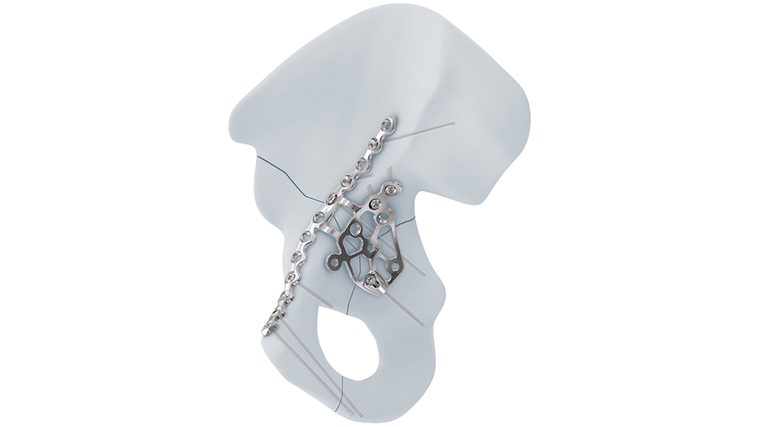 Intrapelvic acetabular system on pelvis 