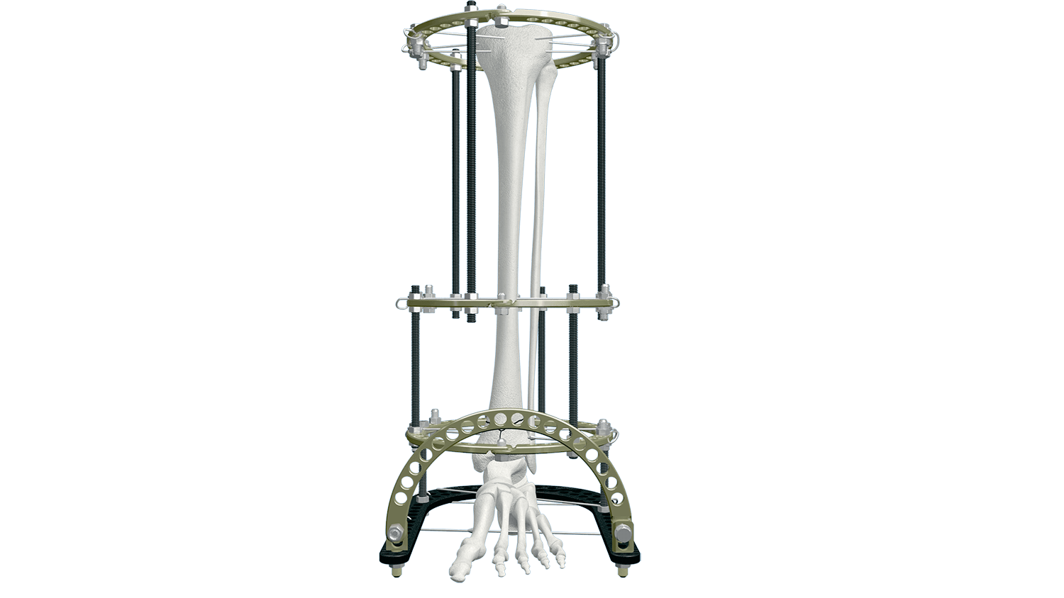 Distraction osteogenesis ring system intra-articular distal tibia frame