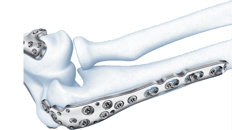 LCP Olecranon Plate attached to bone