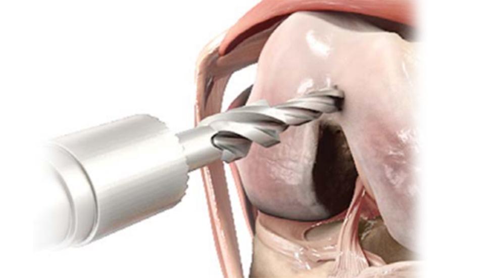  ATTUNE™ Knee System step drill drilling into knee