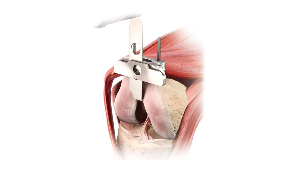 resected distal femur