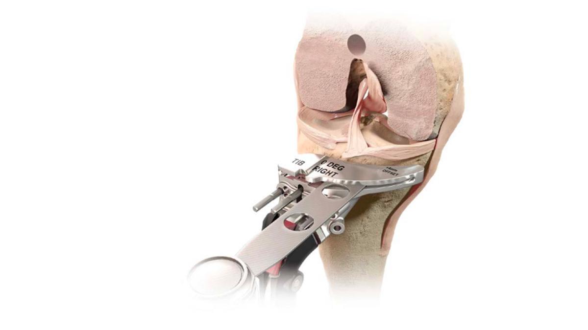  tibia resection during total knee arthroplasty
