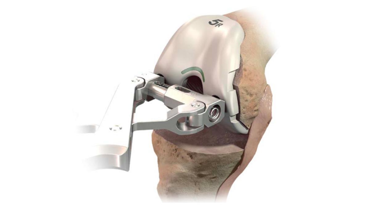 Femoral trial gripper used on knee during total knee arthroplasty