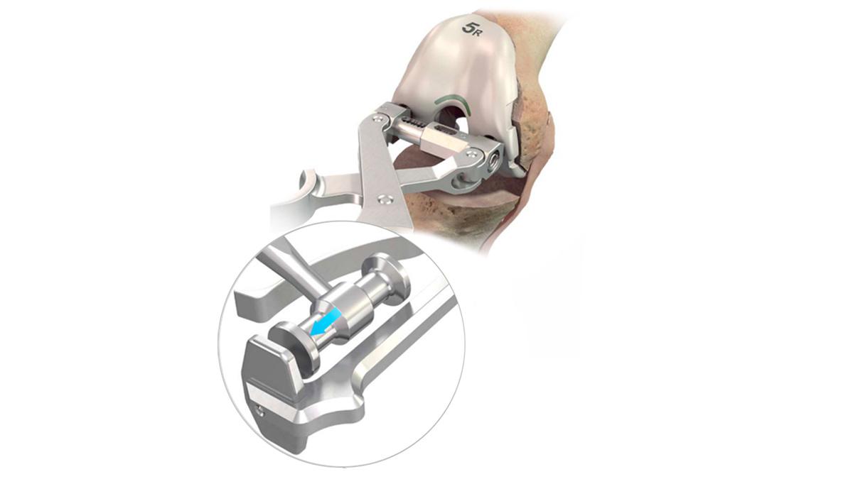 Femoral trial gripper used on knee during total knee arthroplasty