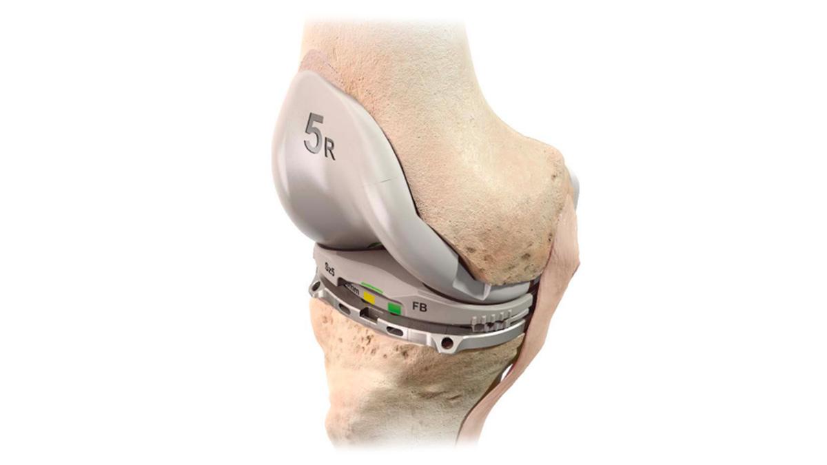 knee with ATTUNE™ Knee System installed