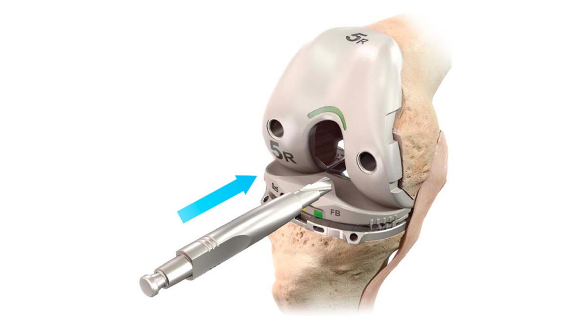 patella lug hole drilling