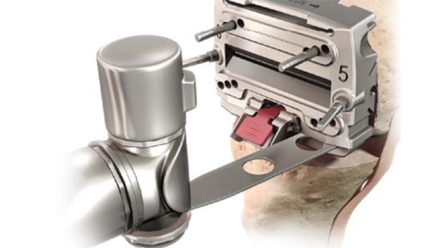 ATTUNE™ Knee System bone saw cutting into knee