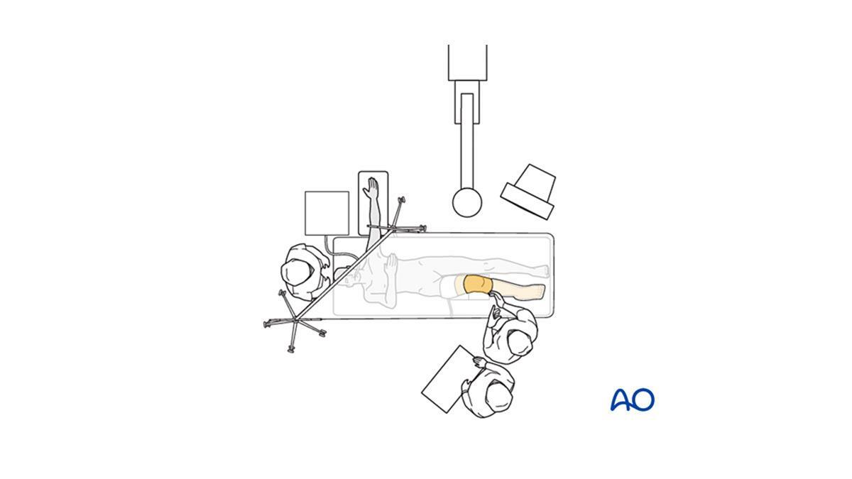 overhead diagram of operating room setup for ATTUNE™ Knee System arthroplasty procedure