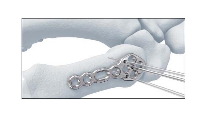 Variable Angle Locking Hand System First Metacarpal Plate Dorsal K-Wire Placement on hand