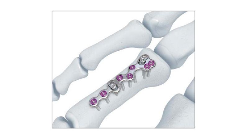 Variable Angle Locking Hand System Fracture Plate Screw Placement in hand