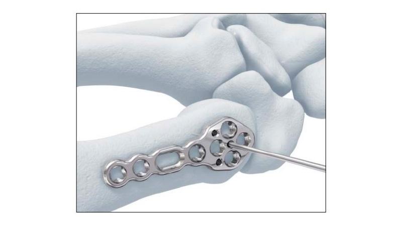 Variable Angle Locking Hand System locking plate positioned onto hand bone