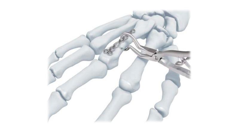 Variable Angle Locking Hand System Plate Holding Forceps holding locking plate to the hand bone