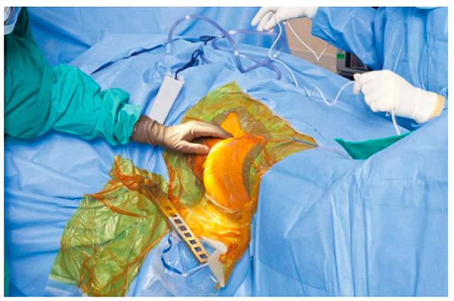 Figure 6 cover skin with iodine incise drape, Figure 7 cut hole in drape for femoral hook lift