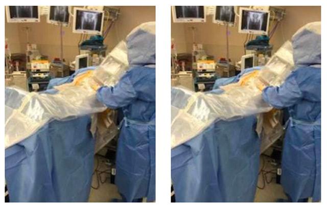 surgeons draping patient for anterior approach total hip replacement on Hana table