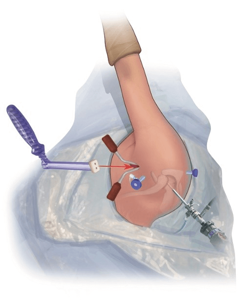Graft Insertion