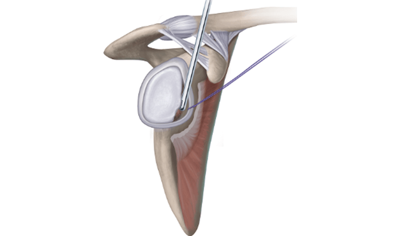 Glenoid Preparation 2