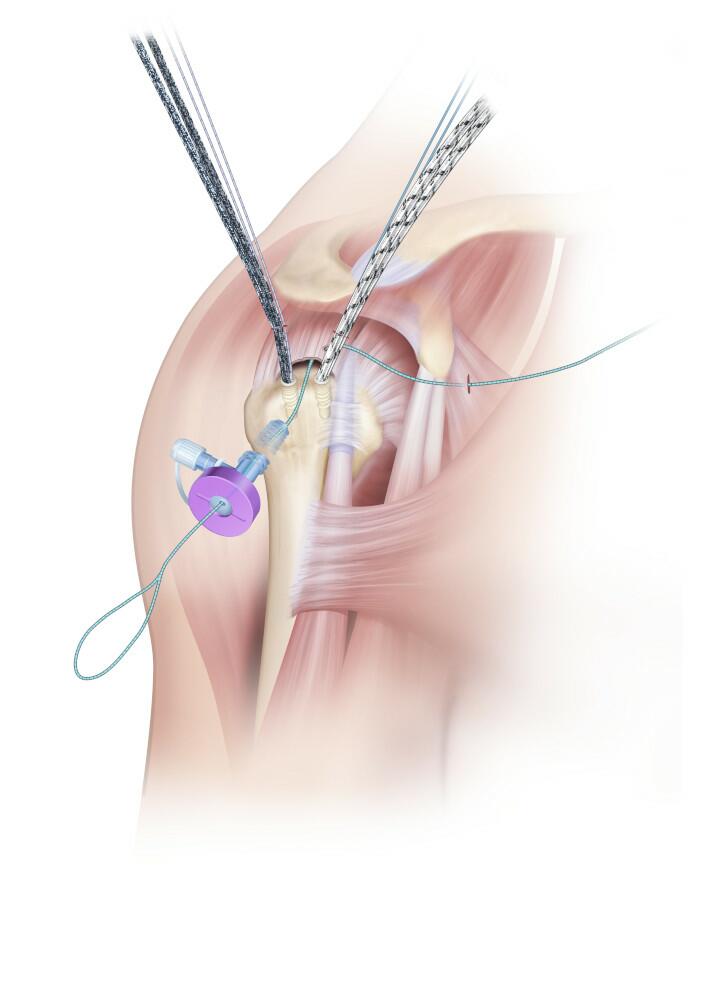 The tail end of the utility shuttle is retrieved out of the anterior portal