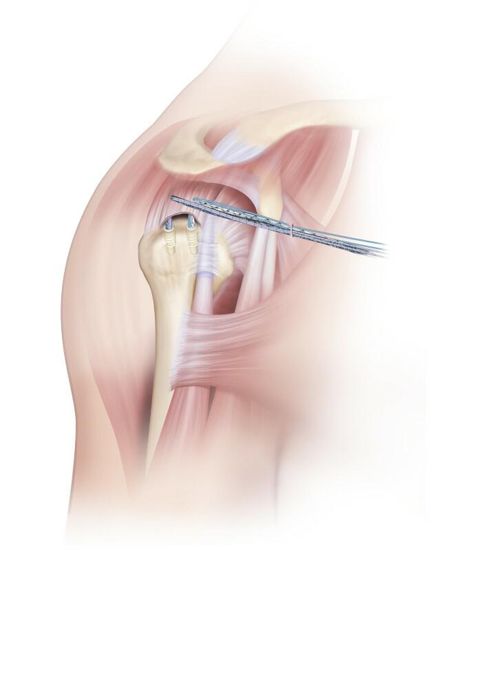 Repeat Steps 3-6 with Posterior DYNATAPE Sutures and DYNACORD Sutures.