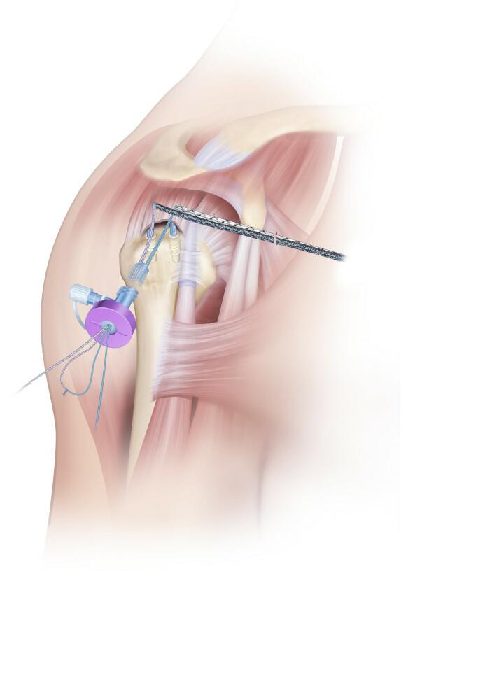 All 4 DYNACORD Sutures are retrieved Out the Lateral Portal