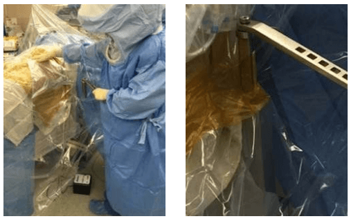 surgeons draping patient for anterior approach total hip replacement on Hana table