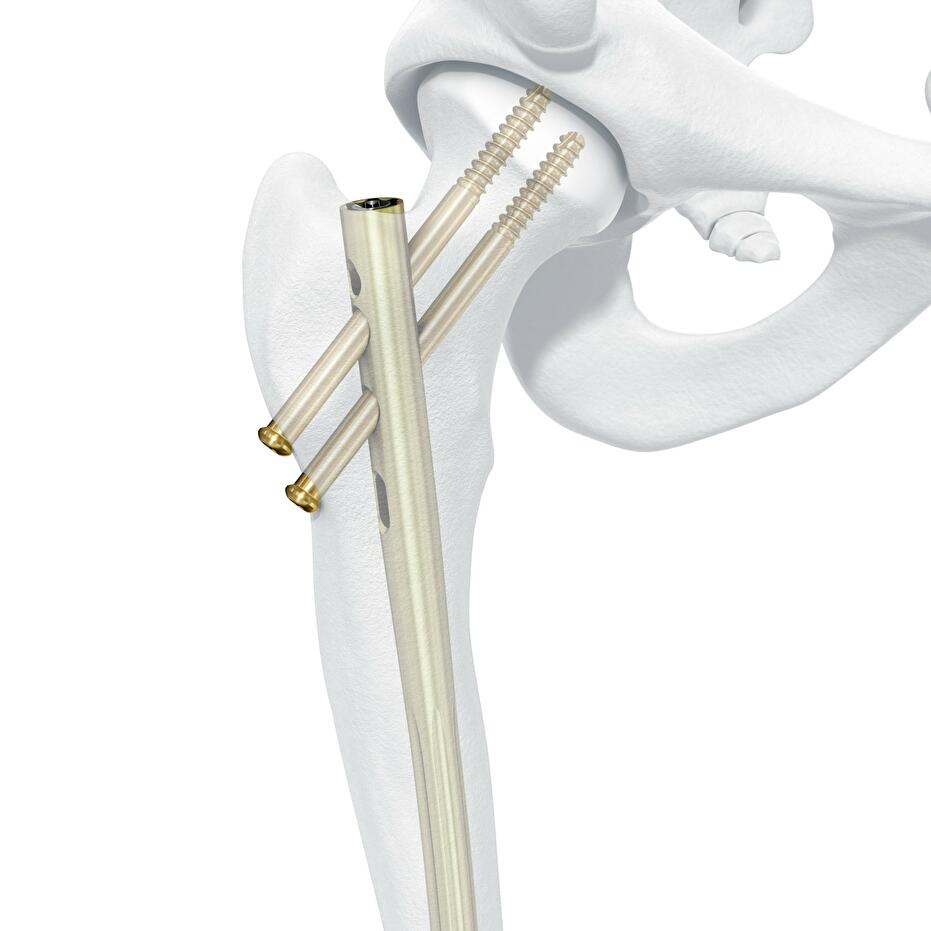Femoral Recon Nail