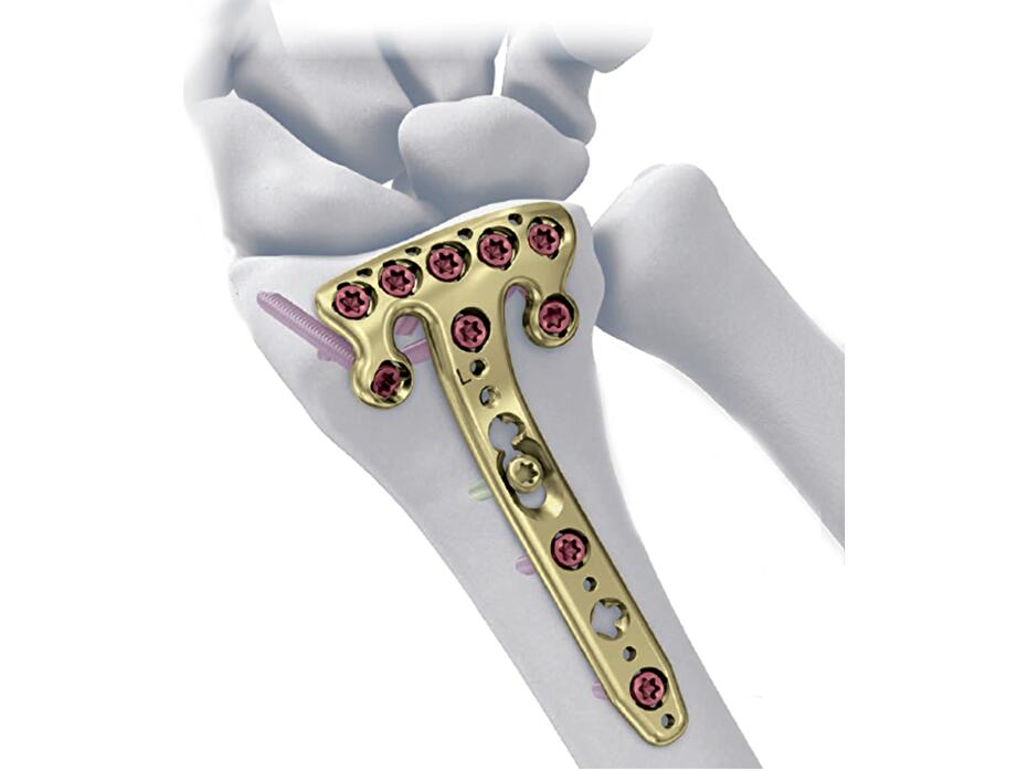 2.4mm Variable Angle LCP® Volar Rim Distal Radius System