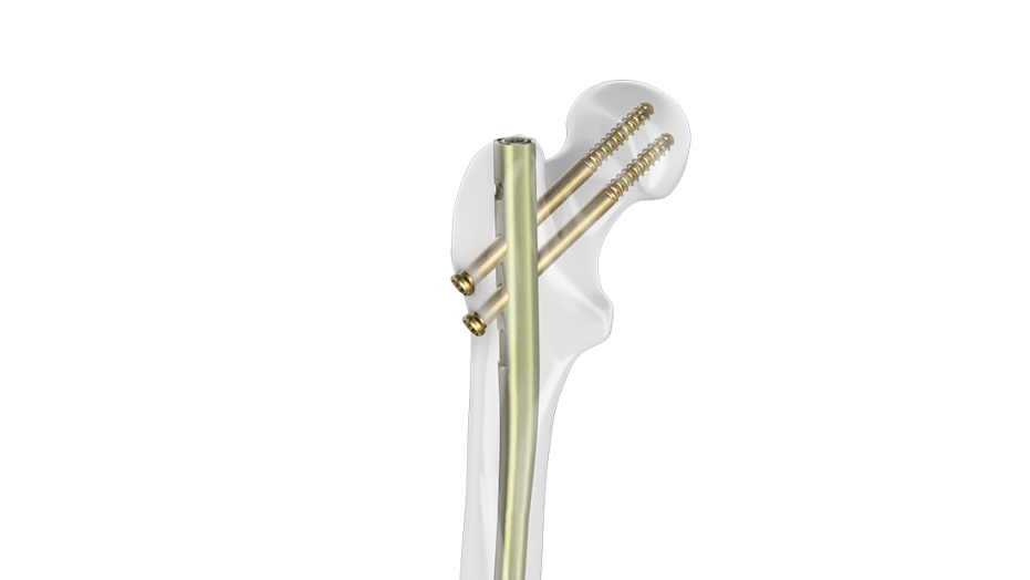 FRN-ADVANCED™ Femoral Nailing System shown up close inserted in place in femur