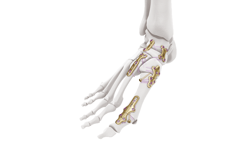 Examples of plates within the Variable Angle LCP Midfoot-Forefoot System in bone