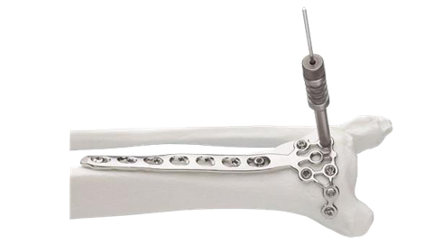 LCP Pilon Plate shown being screwed into the distal tibia