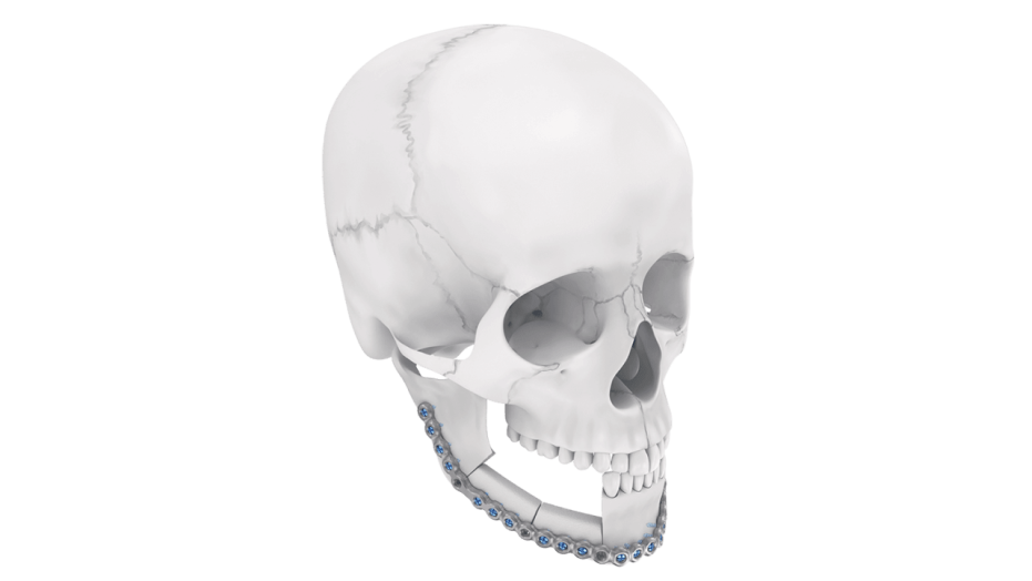 TRUMATCH CMF Plate Contouring shown in place in mandible of skull 