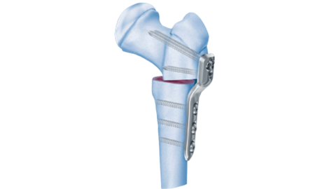 Pediatric LCP Plate System Hip Plate shown in bone in Varus Osteotomy