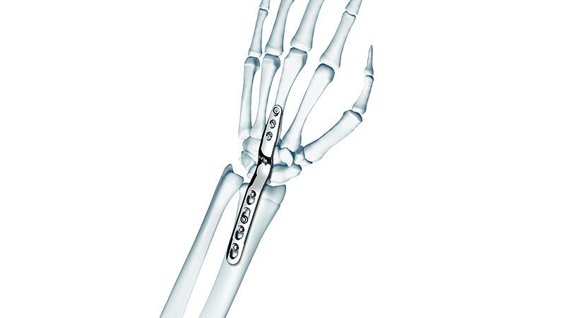 LCPTM Wrist Fusion Set shown attached to bones of wrist and hand